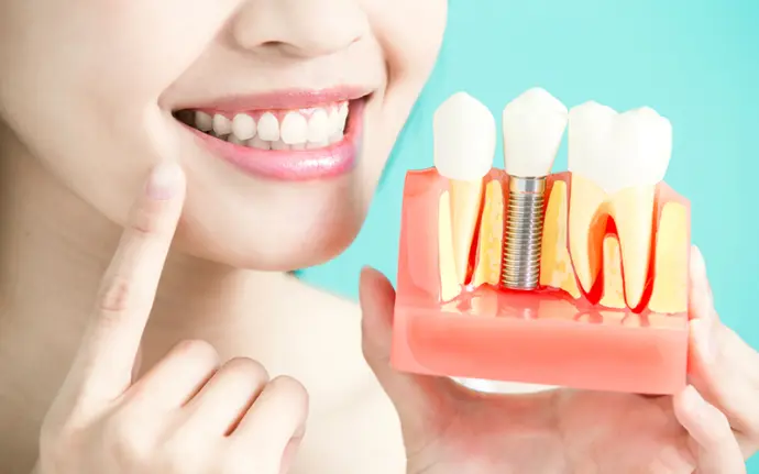 Dental Implants Davie, FL